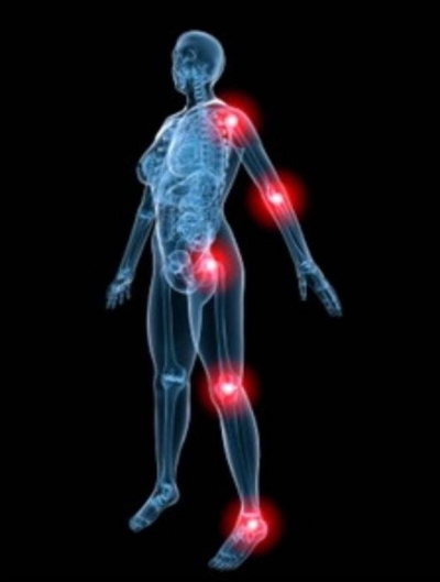 Osteoartrite: sintomas e tratamento (Imagem: divulgação)