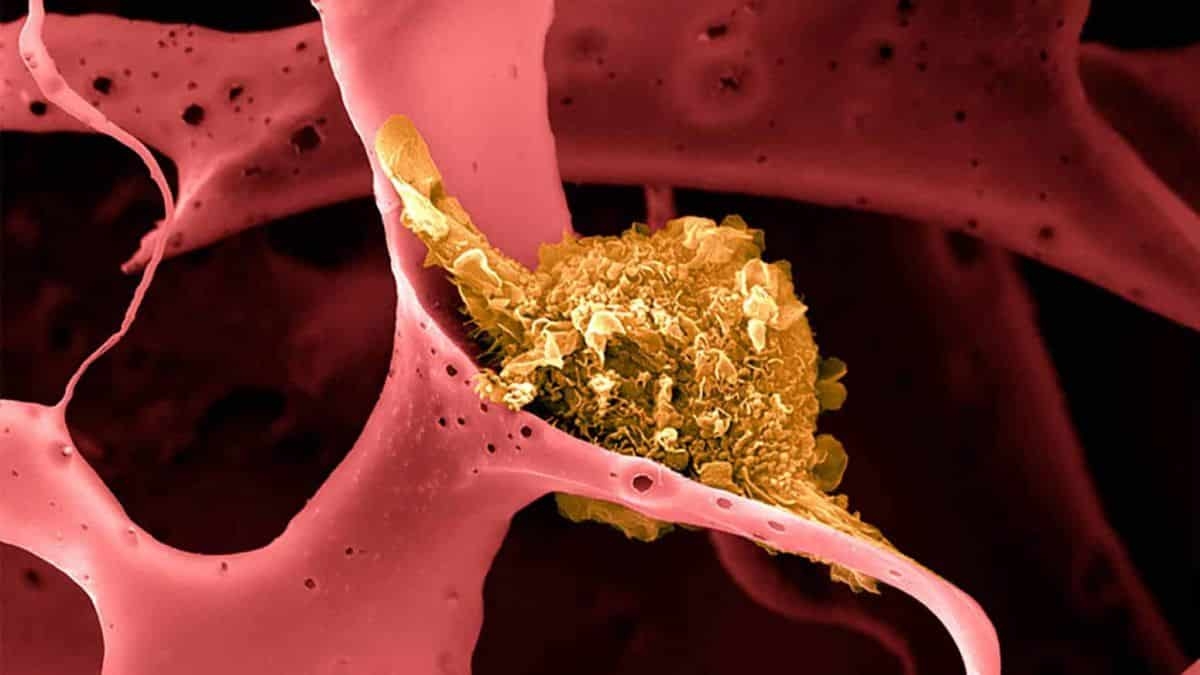 Célula tumoral (Foto: Wyss Institute/ Harvard University)