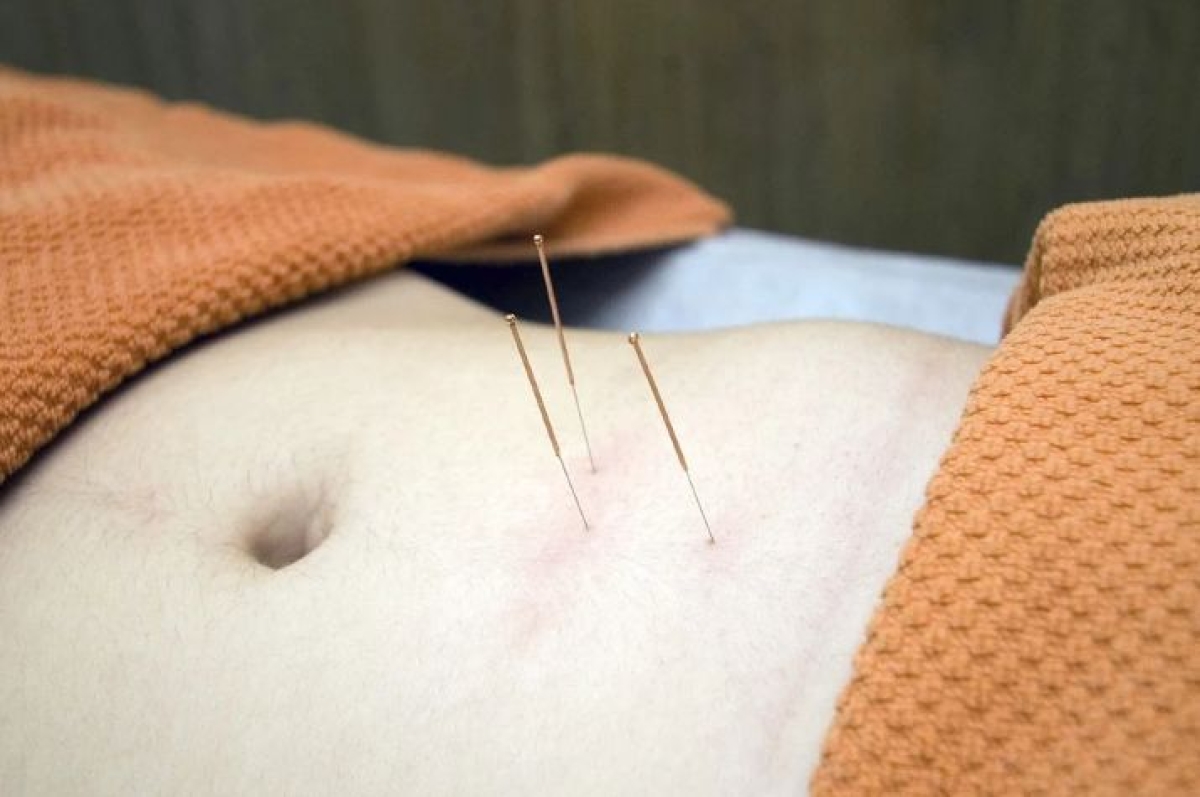 Estudo de Harvard indica benefício da Acupuntura em pacientes de Covid-19 (Foto ilustrativa: Pixabay)