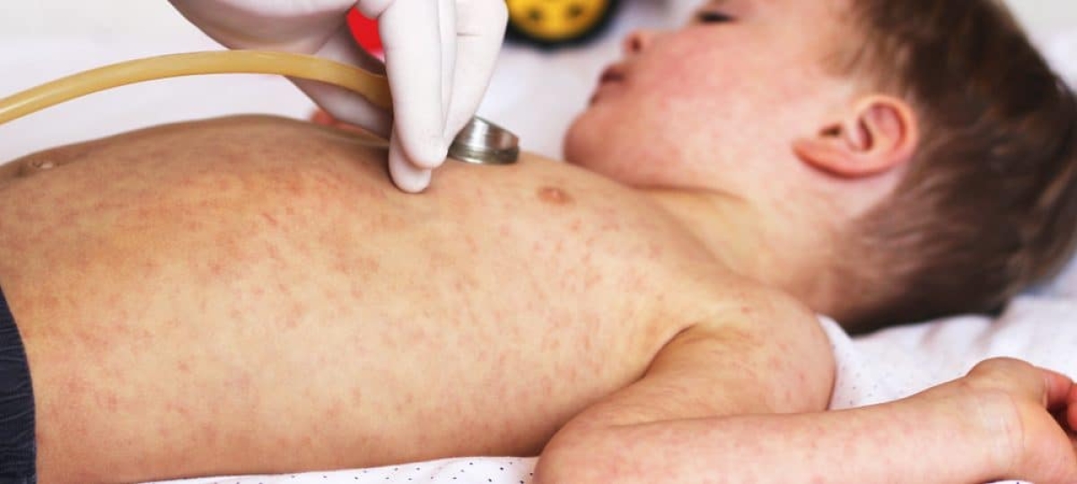 Taxa de transmissão do sarampo é maior que a de Covid-19 - Foto: Olhar Digital