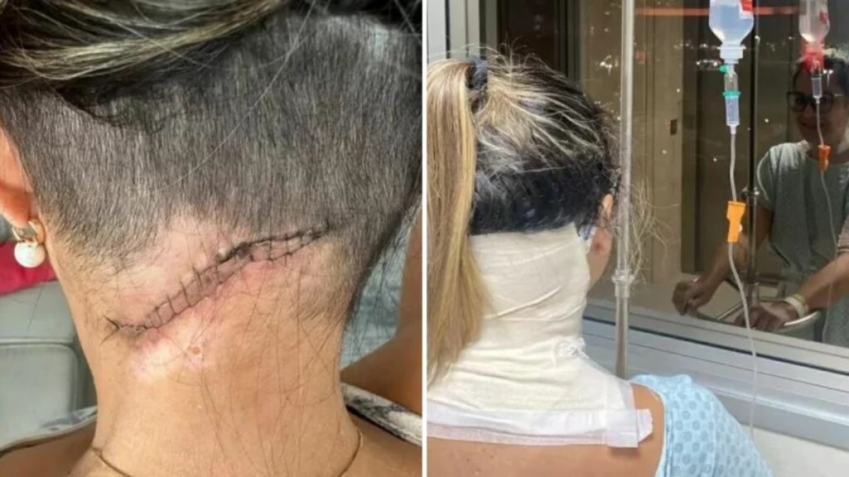 Mulher fica internada após espremer espinha - Foto: Arquivo Pessoal