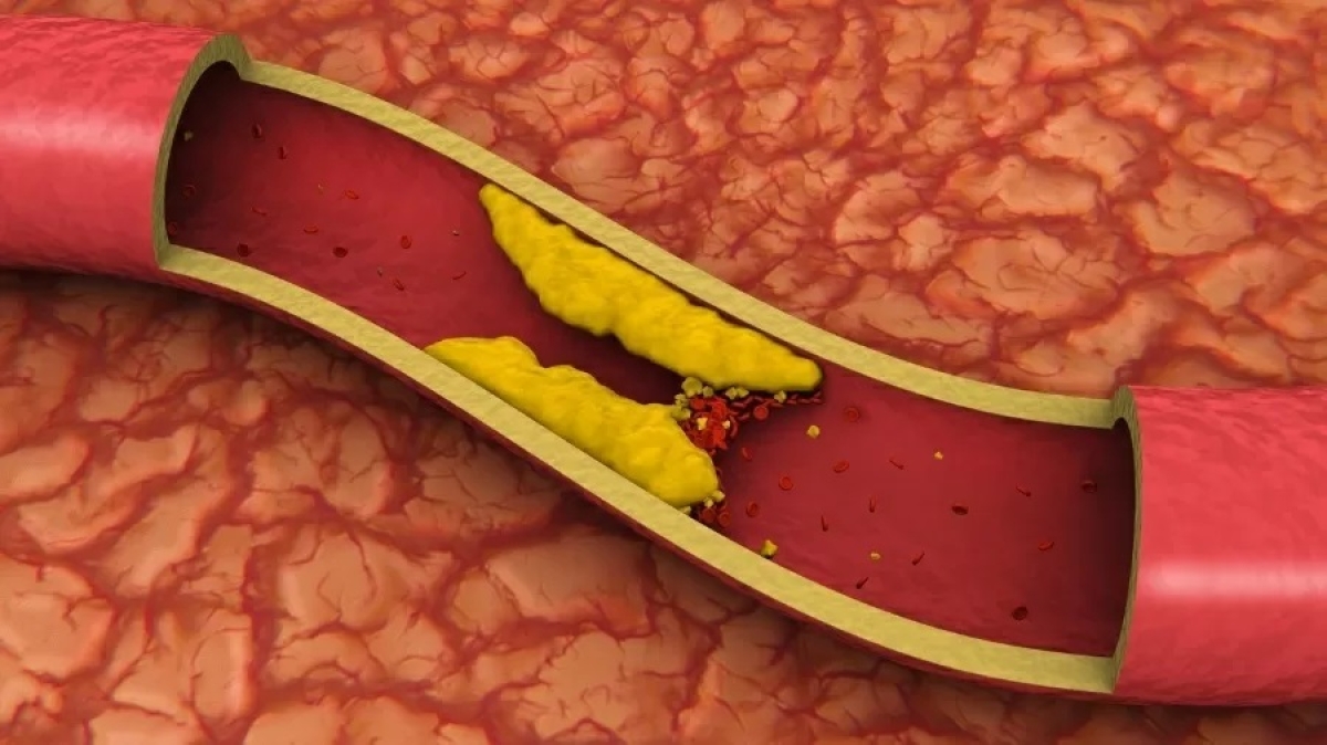 Triglicerídeos alto: qual a taxa normal e como reduzir a gordura no sangue - Foto: Imagem ilustrativa/Getty Images
