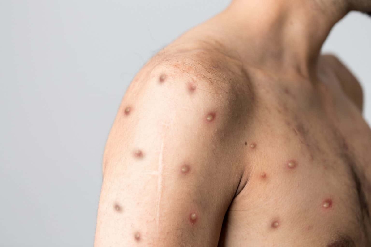 Mpox: saiba o que é, sintomas, prevenção e estratégia de vacinação - Foto: Berkay Ataseven / iStock
